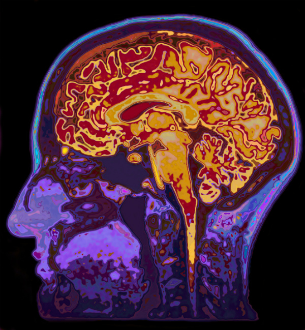 Eine Demenzkrankheit kann auch durch einen MRI festgestellt werden.